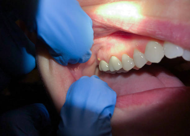 Best Knocked-Out Tooth (Avulsed Tooth) Treatment in Old Bethpage, NY
